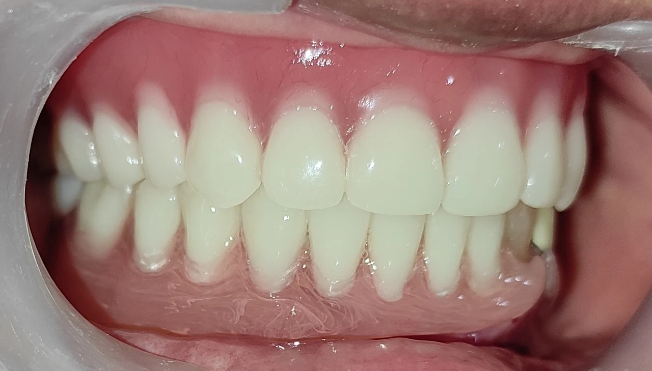 Dental Implants at Care Dental Experts, Palakollu